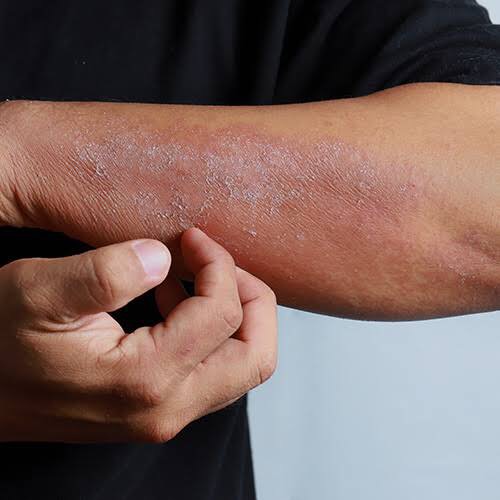 eczema caused by the current heat wave